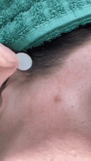 Acne Pimple Patch لاصقات لإزالة حب الشباب